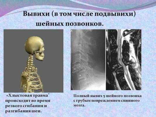 Вывихи (в том числе подвывихи) шейных позвонков