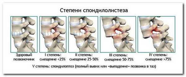 Так схематически можно изобразить смещение позвонка шейного отдела