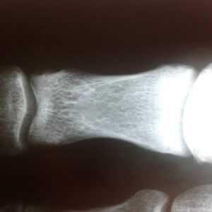 Рентген фаланг пальцев