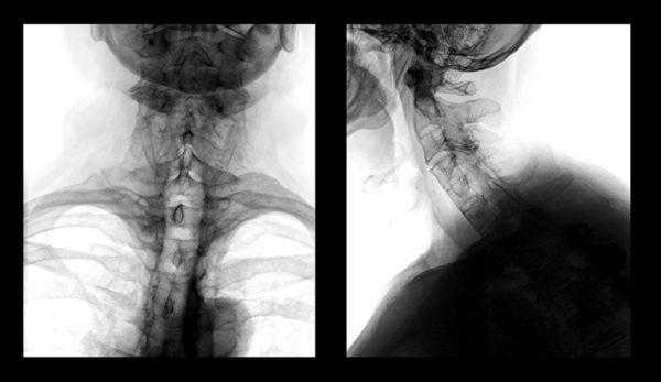 Рентген шеи