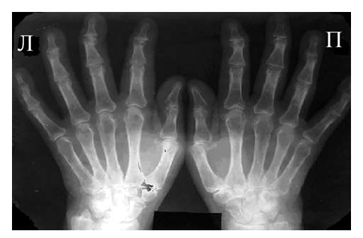 Рис. 3 Сочетание ревматоидного артрита и остеоартроза