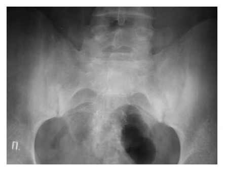 Рис. 7. Двусторонний сакроилиит у больного серонегативным спондилоартритом.