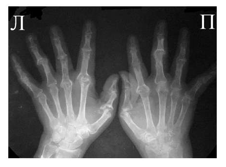 Рис. 5 Множественный остеолиз и деструкции эпифизов костей с разнонаправленными деформа­циями суставов при псориатическом артрите.