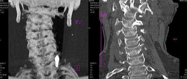 Подвывих шейного позвонка