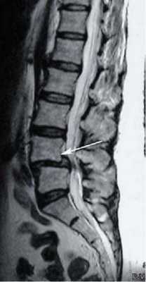 Так выглядит смещение пятого позвонка на МРТ