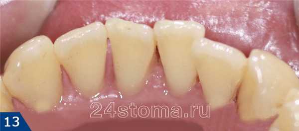 Вид зубов после их очистки Air Flow (большое количество пигментного зубного налета)