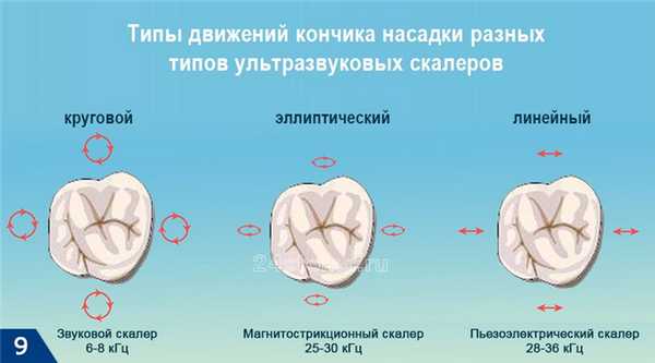 Типы движений кончика насадки разных типов ультразвуковых скалеров
