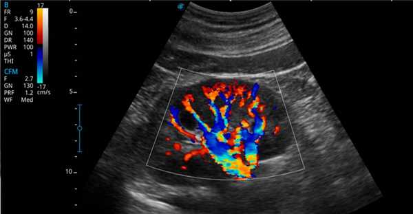 Пример визуализации (изображения) на УЗИ аппарате