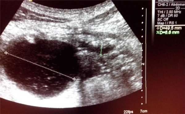 кисты поджелудочной