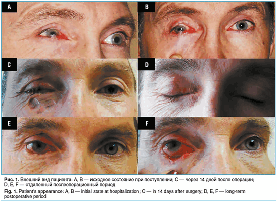 Рис. 1. Внешний вид пациента: A, B — исходное состояние при поступлении; C — через 14 дней после операции; D, E, F — отдаленный послеоперационный период Fig. 1. Patient’s appearance: A, B — initial state at hospitalization; C — in 14 days after surgery; D