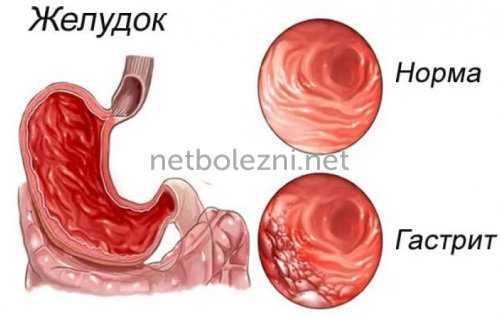 Заболевание желудка гастрит
