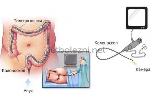 Как выглядит колоноскопия