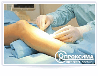 Особенности лечения свища