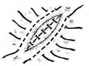 Зашивание раны легкого швом Тигеля