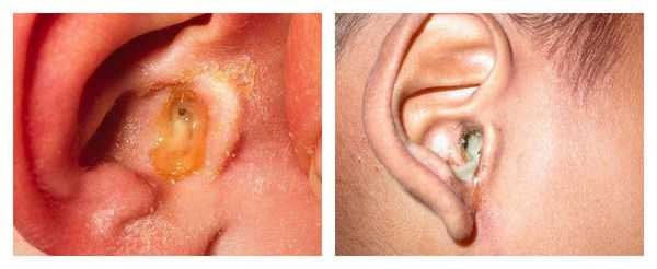 Патологические выделения из уха