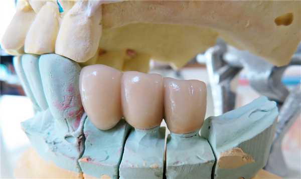 Виды мостовидных протезов