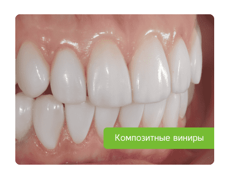 композитные виниры