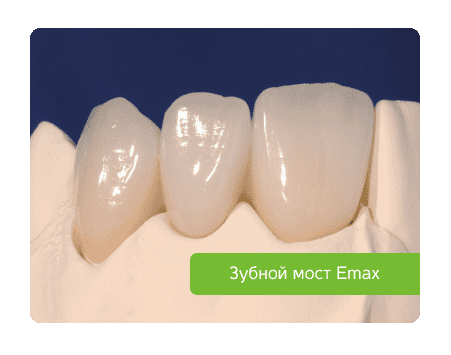 керамический зубной мост
