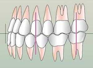 Центральная окклюзия