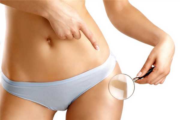 Целлюлит — враг красоты женских ног