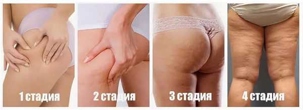 стадии целлюлита