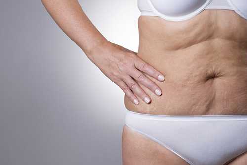 Как убрать дряблость кожи тела