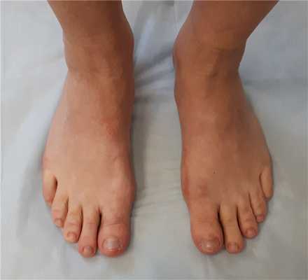 год после операции халлюс вальгус