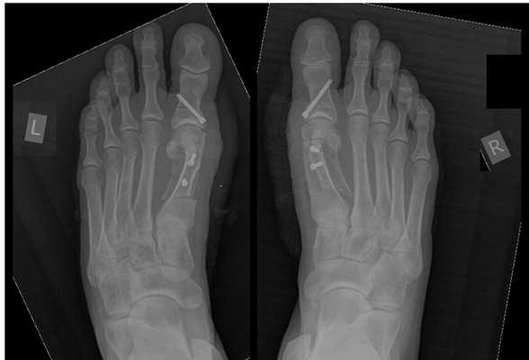 Халюс Вальгус рентгенограммы после операции