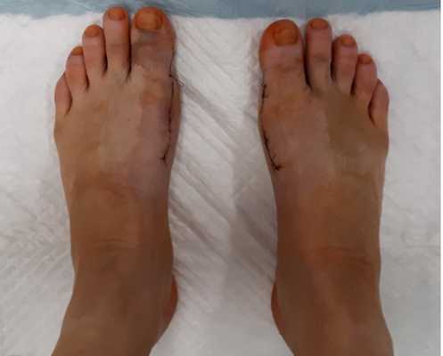 пятые сутки после операции косточка на большом пальце ноги