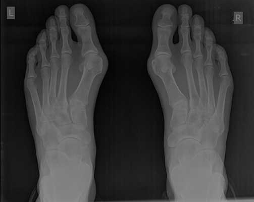 Халюс Вальгус рентгенограммы до