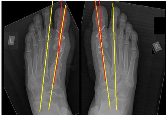 Косточка на большом пальце рентгенограммы после операции углы