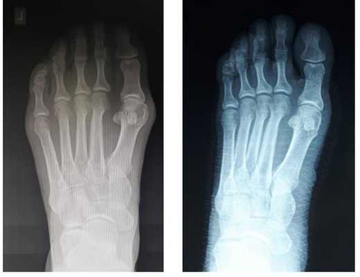косточка на большом пальце 1 степени рентген 