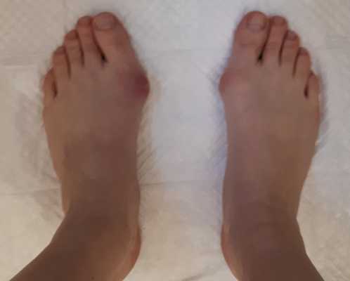 Халюс Вальгус фото до