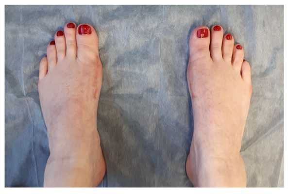 Hallux valgus 6 недель после операции