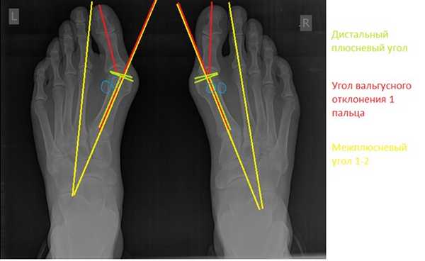 Косточка на большом пальце планирование операции