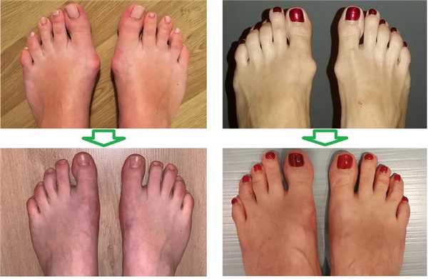 операция при халюс вальгус