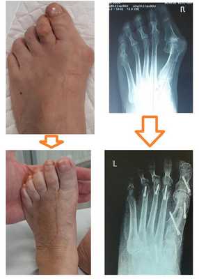 операция на косточке большого пальца ноги
