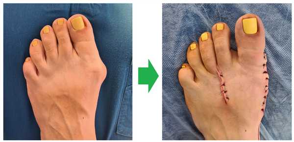 операция на косточке стопы