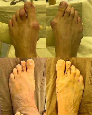 операция по коррекции стопы