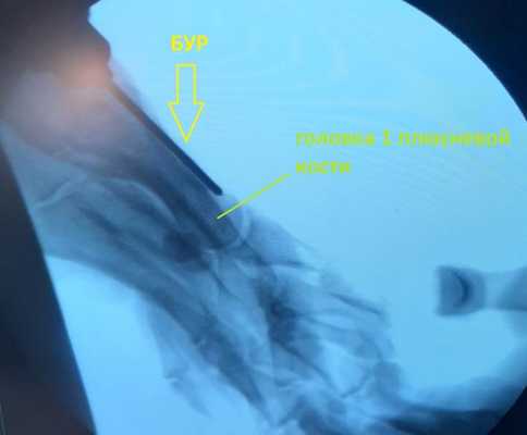 миниинвазивная операция по удалению косточки