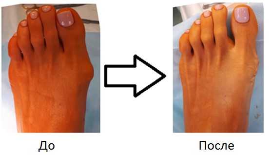 операция на косточке большого пальца ноги 1