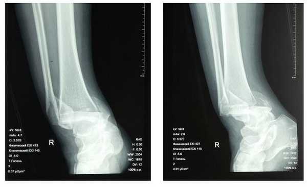 перелом ноги