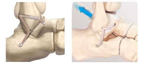 пластика связок голеностопа латеральный отдел