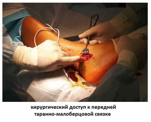 нестабильность голеностопного сустава лечение