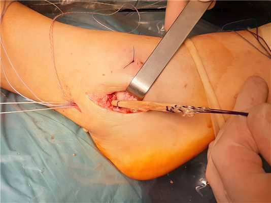 пластика латеральных связок голеностопа аутосухожилием