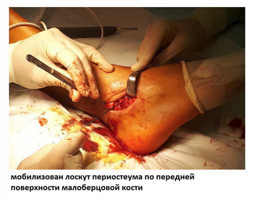 нестабильность голеностопного сустава восстановление связок