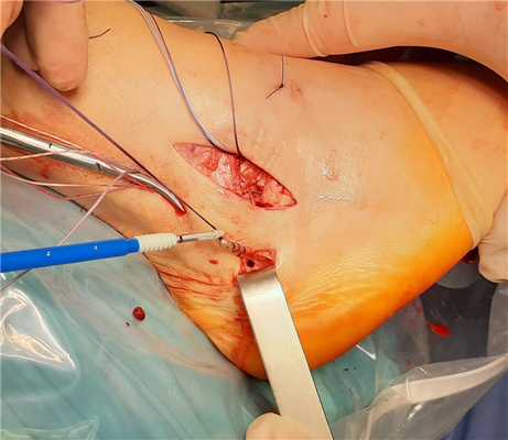 фиксация пяточно-малоберцовой связки биотенодезным винтом