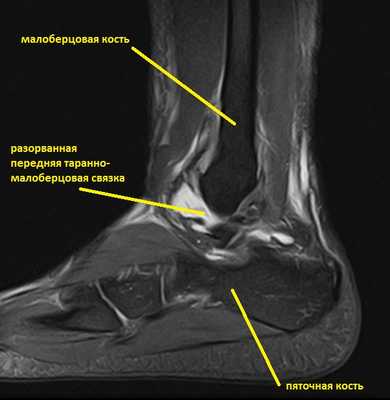 разрыв связок голеностопа мрт