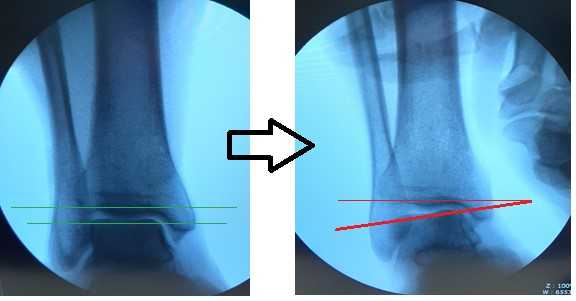 варус стресс тест для подтверждения нестабильности голеностопа