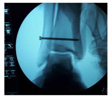 после восстановления связок голеностопа рентген